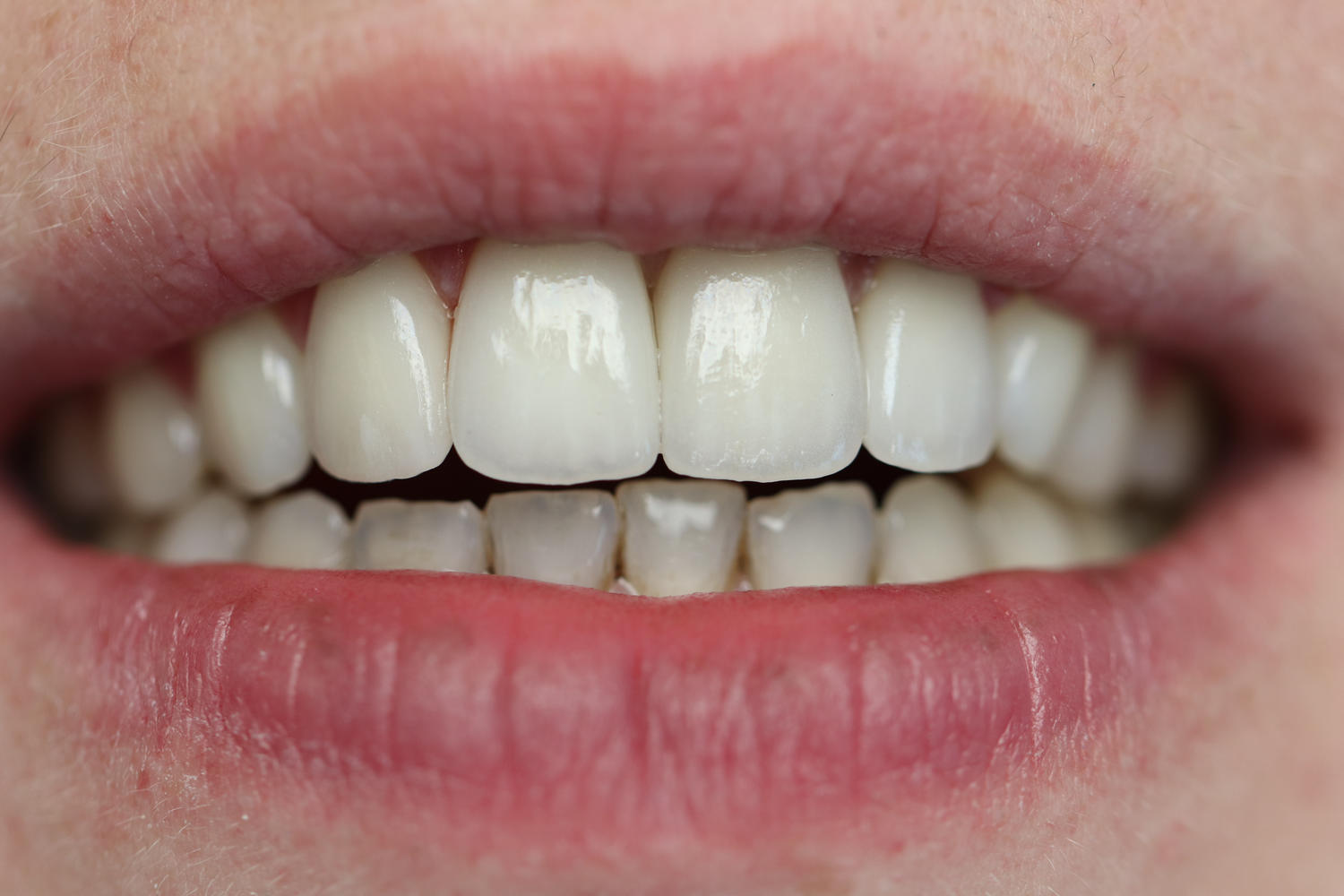 Veneers
